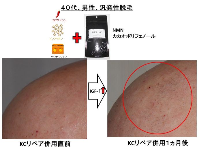 円形脱毛症　病院
